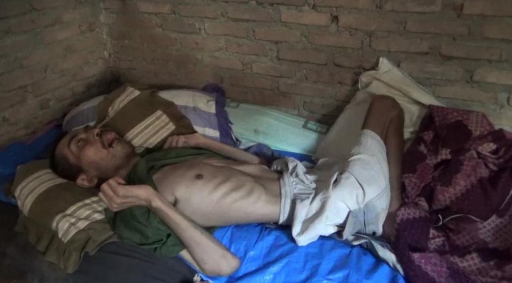 Kurang Gizi dan Derita Epilepsi, Seorang Pria di Tanggamus Enam Tahun Terbaring Lemah